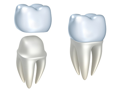 Small teeth? Crown dragging will make you smile more