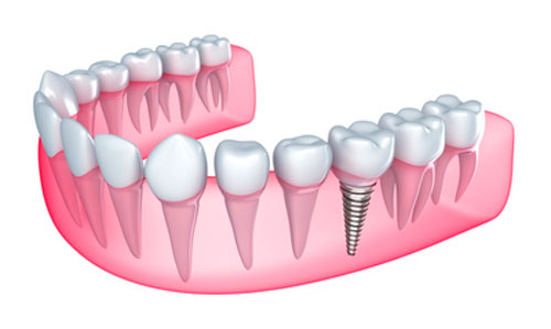 Will Your Dental Implants Affect Your MRI