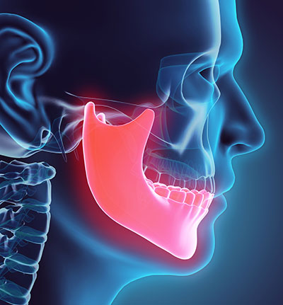 Rendering of facial bones with low jaw shown glowing in red in San Jose