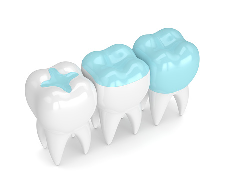 Rendering of dental filling at Nancy Shiba, DDS in San Jose, CA