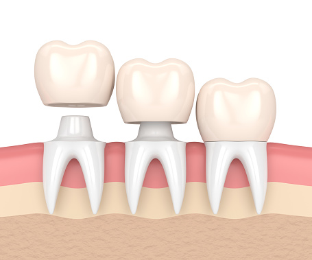 image of crowns