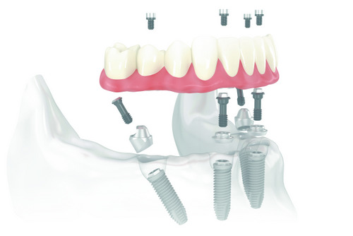 What are All on Four Implants exactly?