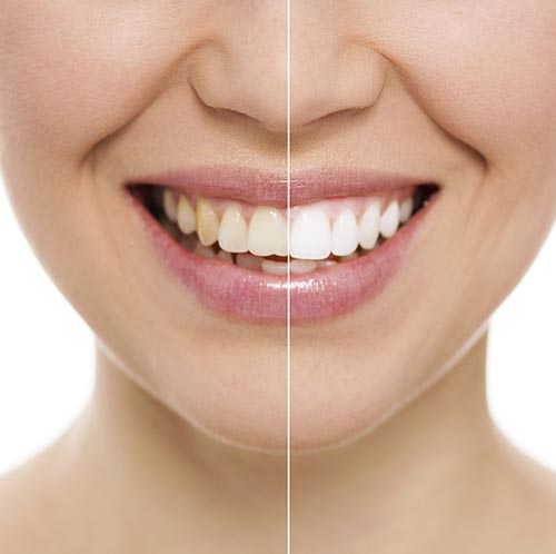 How You Can Use Water To Prevent Other Beverages From Staining Your Teeth