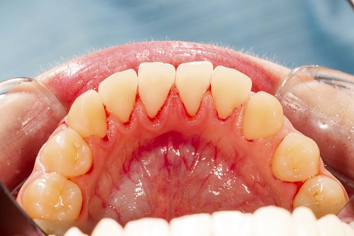 A patients mouth suffering from gun disease.